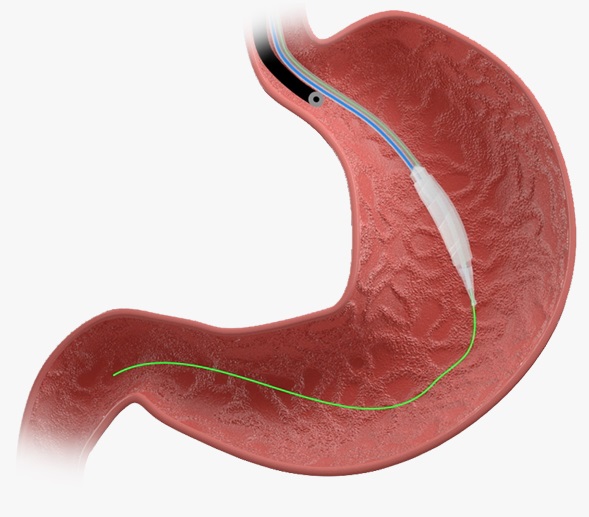 Stella Intragastric Balloon